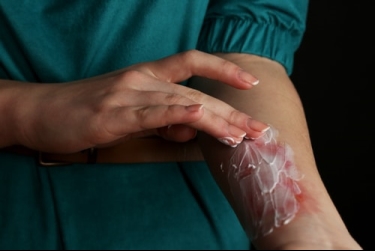 Burn Injury on Arm