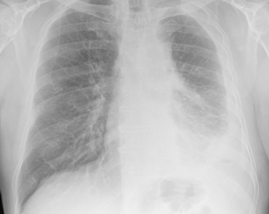 a chest x-ray of a person